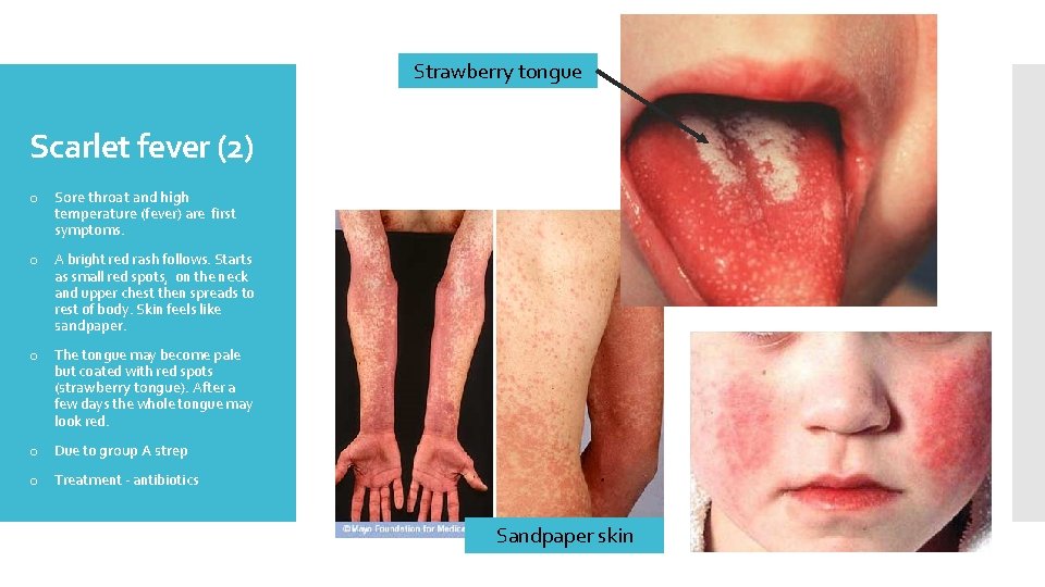 Strawberry tongue Scarlet fever (2) o Sore throat and high temperature (fever) are first