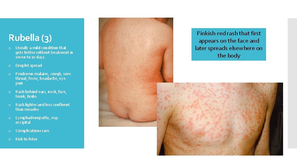 Rubella (3) o Usually a mild condition that gets better without treatment in seven