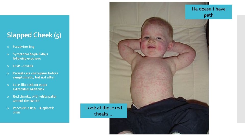 He doesn’t have path Slapped Cheek (5) o Parvovirus B 19 o Symptoms begin