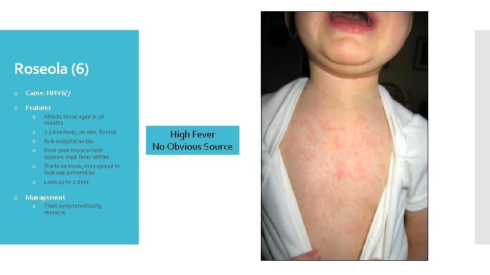 Roseola (6) o Cause: HHV 6/7 o Features o o o Affects those aged