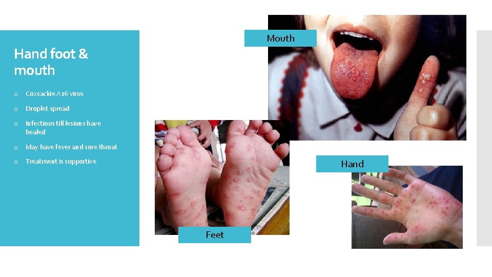 Mouth Hand foot & mouth o Coxsackie A 16 virus o Droplet spread o