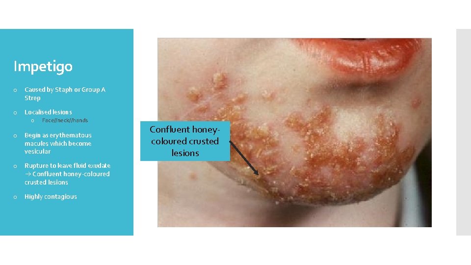 Impetigo o Caused by Staph or Group A Strep o Localised lesions o Face//neck//hands
