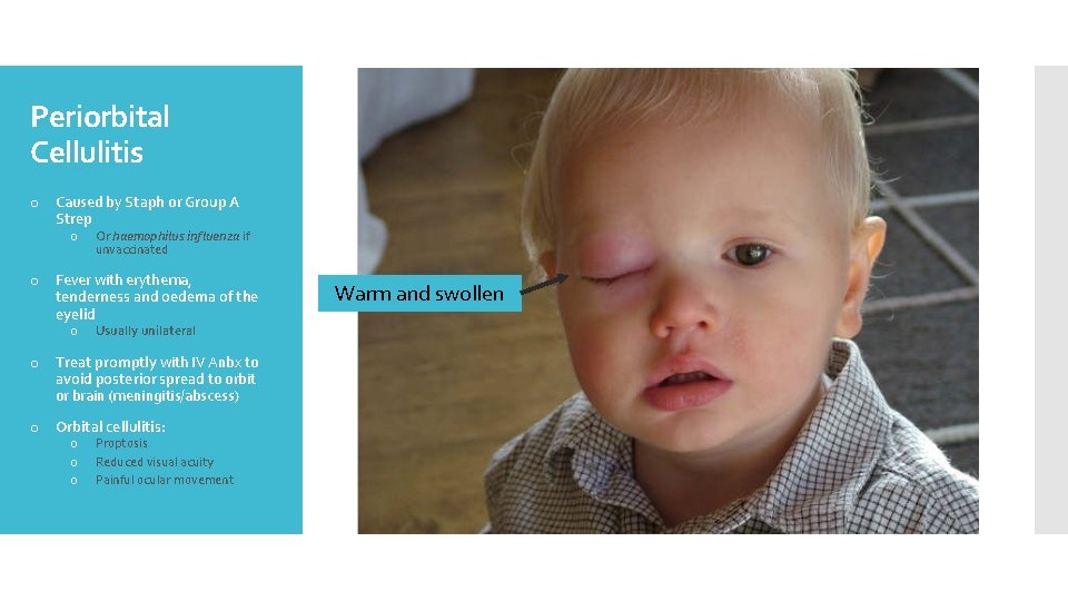 Periorbital Cellulitis o Caused by Staph or Group A Strep o Or haemophilus influenza