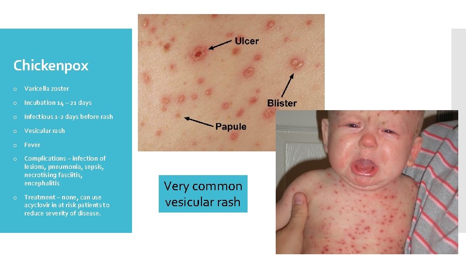Chickenpox o Varicella zoster o Incubation 14 – 21 days o Infectious 1 -2