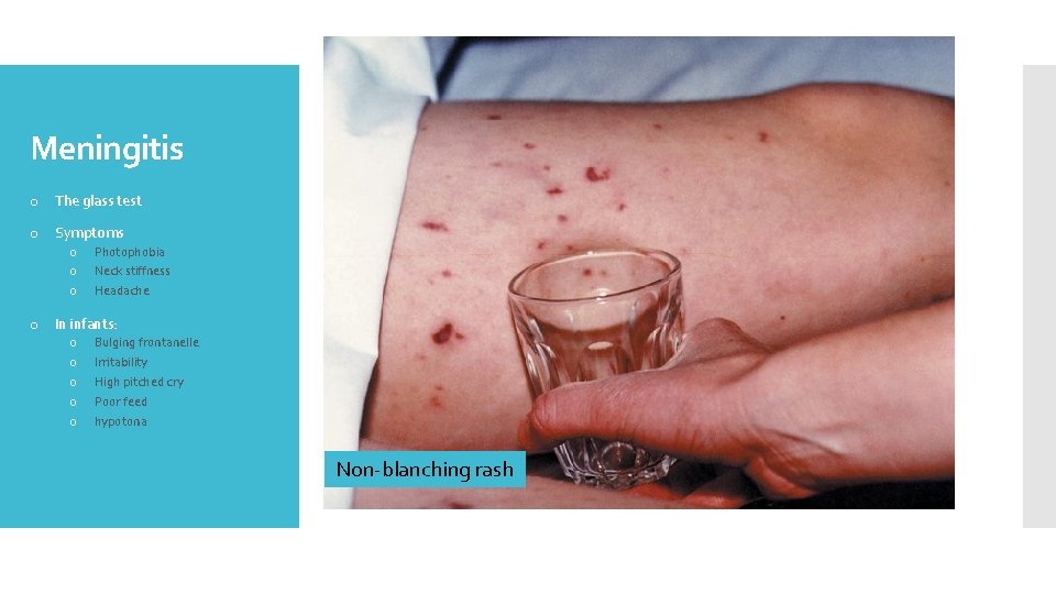 Meningitis o The glass test o Symptoms o o o Photophobia Neck stiffness Headache