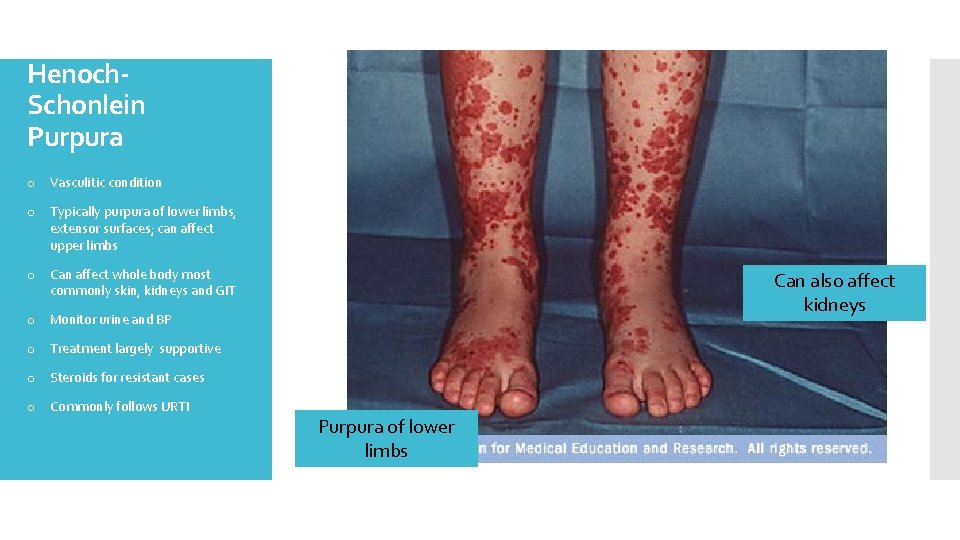 Henoch. Schonlein Purpura o Vasculitic condition o Typically purpura of lower limbs, extensor surfaces;