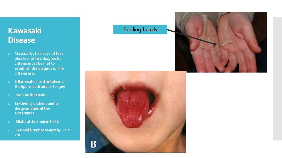 Kawasaki Disease o Classically, five days of fever plus four of five diagnostic criteria