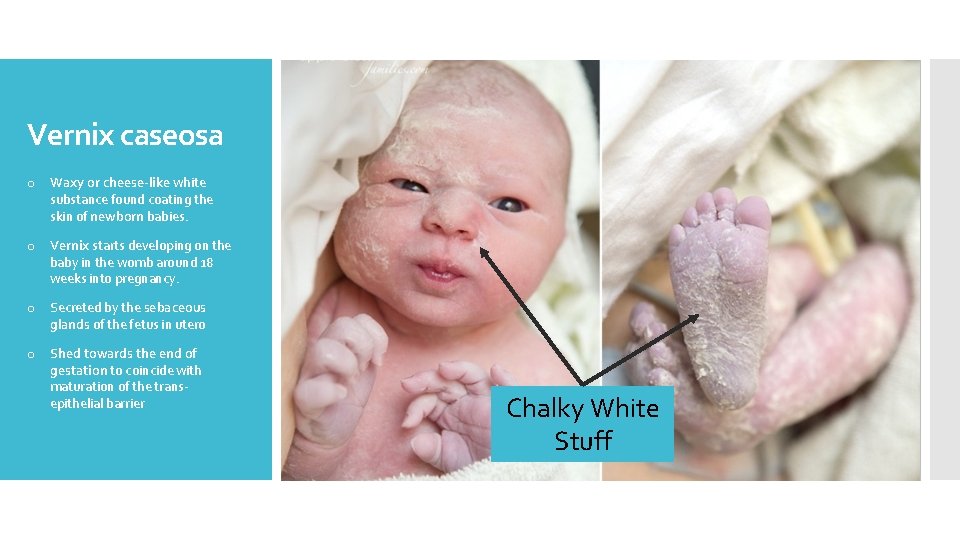 Vernix caseosa o Waxy or cheese-like white substance found coating the skin of newborn