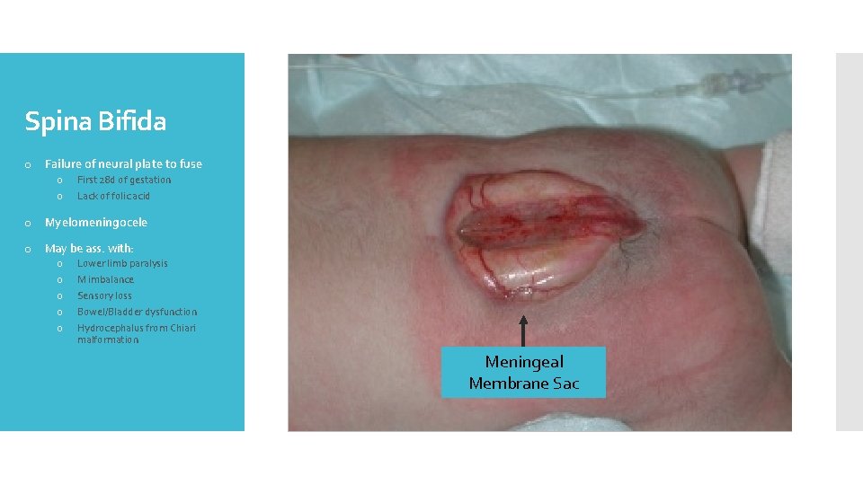Spina Bifida o Failure of neural plate to fuse o o First 28 d