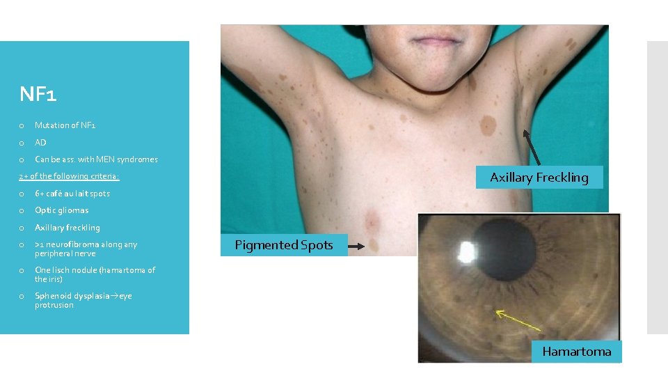 NF 1 o Mutation of NF 1 o AD o Can be ass. with