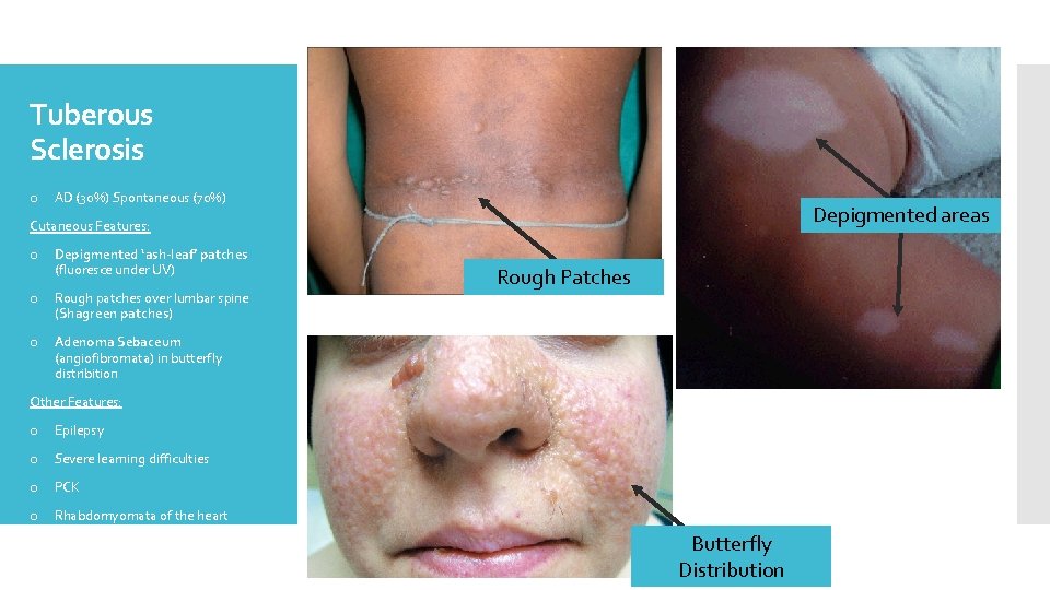 Tuberous Sclerosis o AD (30%) Spontaneous (70%) Depigmented areas Cutaneous Features: o Depigmented ‘ash-leaf’
