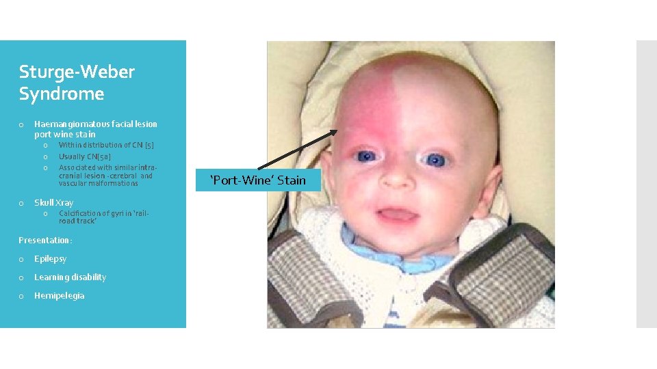 Sturge-Weber Syndrome o Haemangiomatous facial lesion port wine stain o o o Within distribution