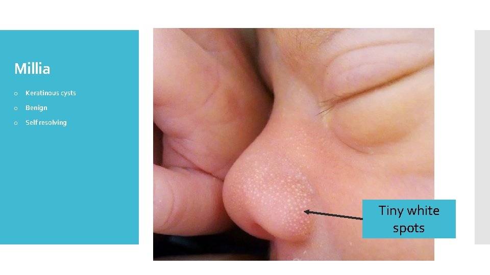 Millia o Keratinous cysts o Benign o Self resolving Tiny white spots 