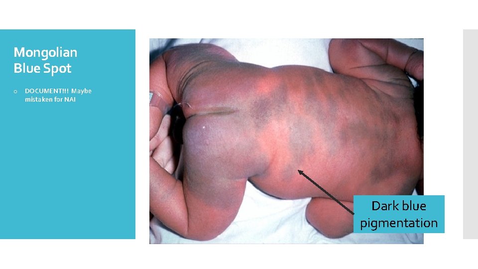 Mongolian Blue Spot o DOCUMENT!!! Maybe mistaken for NAI Dark blue pigmentation 