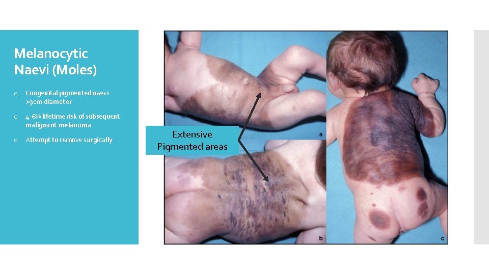 Melanocytic Naevi (Moles) o Congenital pigmented naevi >9 cm diameter o 4 -6% lifetime