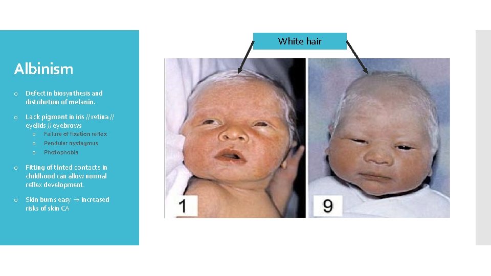 White hair Albinism o Defect in biosynthesis and distribution of melanin. o Lack pigment