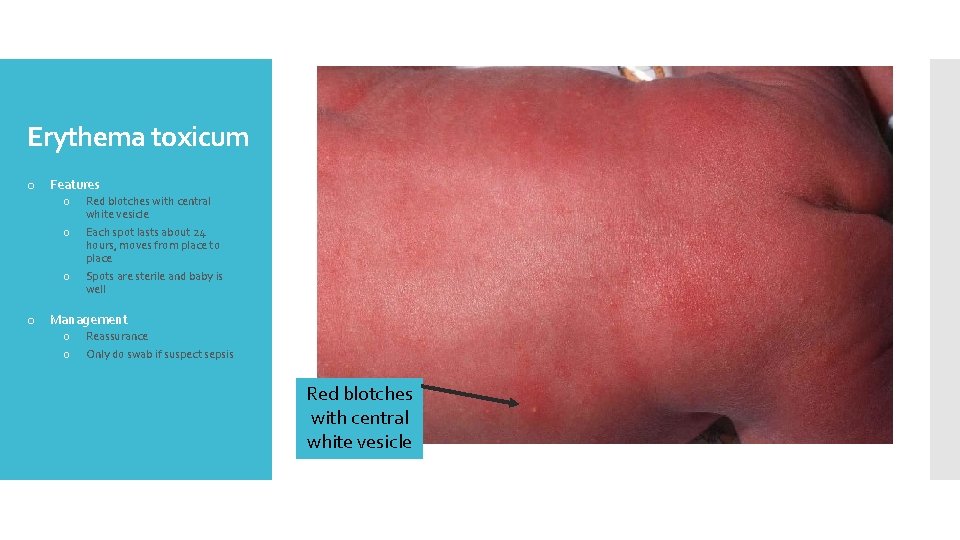 Erythema toxicum o Features o o o Red blotches with central white vesicle Each