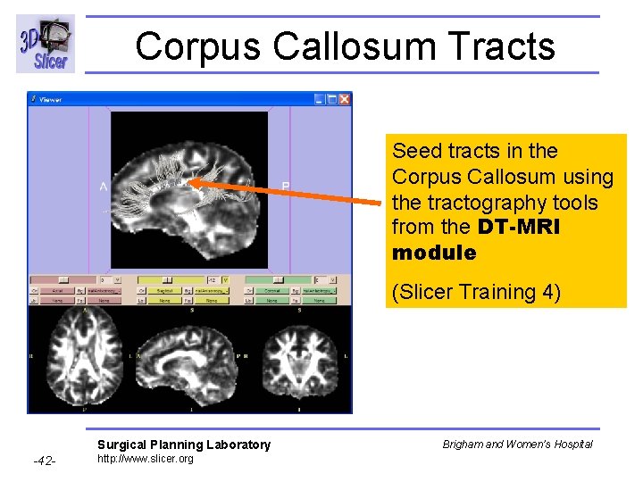 Corpus Callosum Tracts Seed tracts in the Corpus Callosum using the tractography tools from