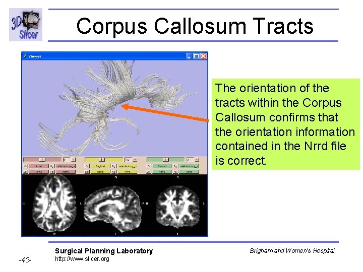 Corpus Callosum Tracts The orientation of the tracts within the Corpus Callosum confirms that
