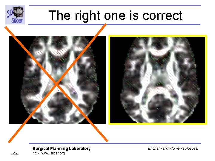 The right one is correct Surgical Planning Laboratory -44 - http: //www. slicer. org