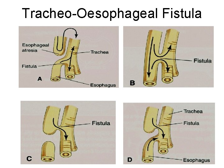 Tracheo-Oesophageal Fistula 