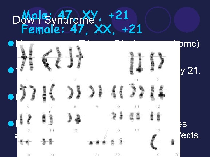 Male: 47, XY, +21 Down Syndrome Female: 47, XX, +21 l Most common, Trisomy