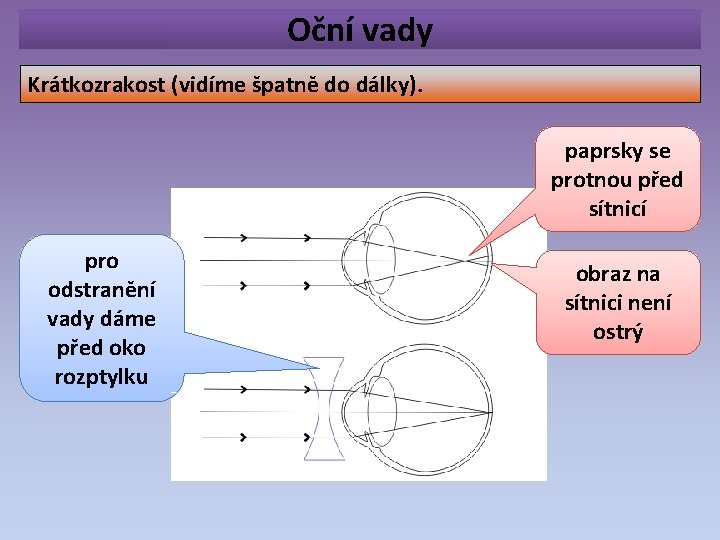 Oční vady Krátkozrakost (vidíme špatně do dálky). paprsky se protnou před sítnicí pro odstranění