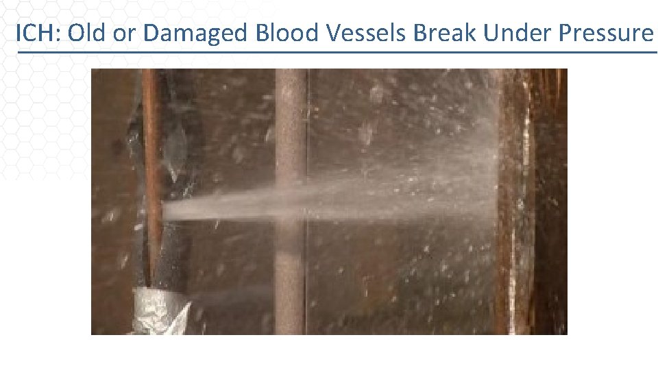 ICH: Old or Damaged Blood Vessels Break Under Pressure 