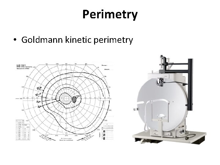 Perimetry • Goldmann kinetic perimetry 