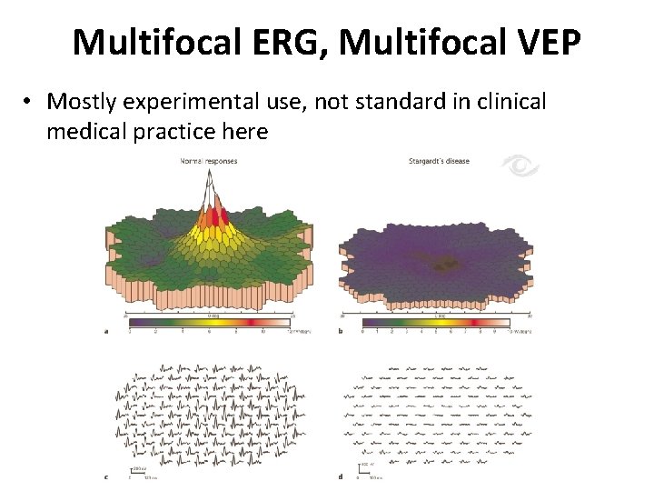 Multifocal ERG, Multifocal VEP • Mostly experimental use, not standard in clinical medical practice