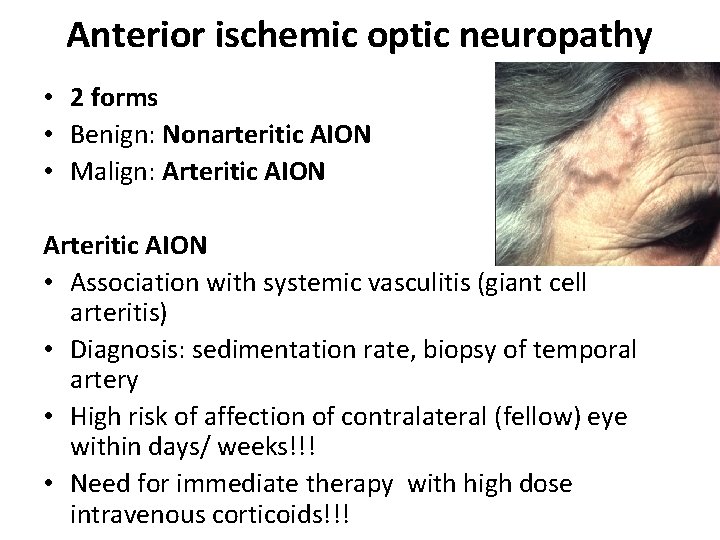 Anterior ischemic optic neuropathy • 2 forms • Benign: Nonarteritic AION • Malign: Arteritic