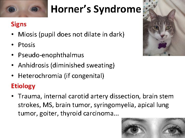 Horner’s Syndrome Signs • Miosis (pupil does not dilate in dark) • Ptosis •