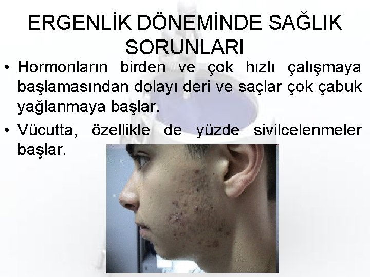 ERGENLİK DÖNEMİNDE SAĞLIK SORUNLARI • Hormonların birden ve çok hızlı çalışmaya başlamasından dolayı deri