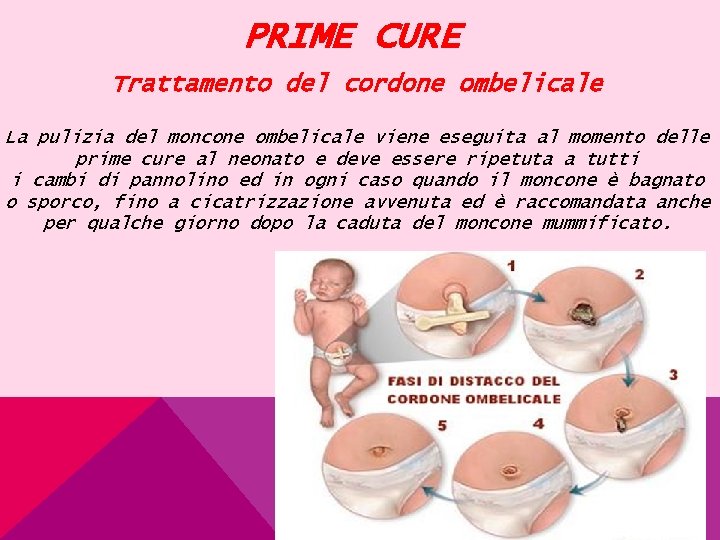 PRIME CURE Trattamento del cordone ombelicale La pulizia del moncone ombelicale viene eseguita al