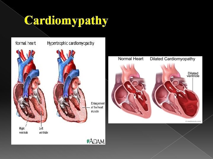 Cardiomypathy 