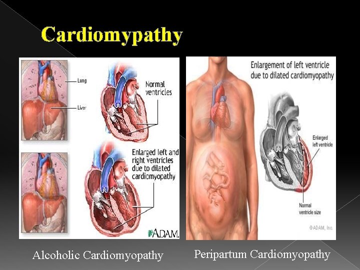 Cardiomypathy Alcoholic Cardiomyopathy Peripartum Cardiomyopathy 