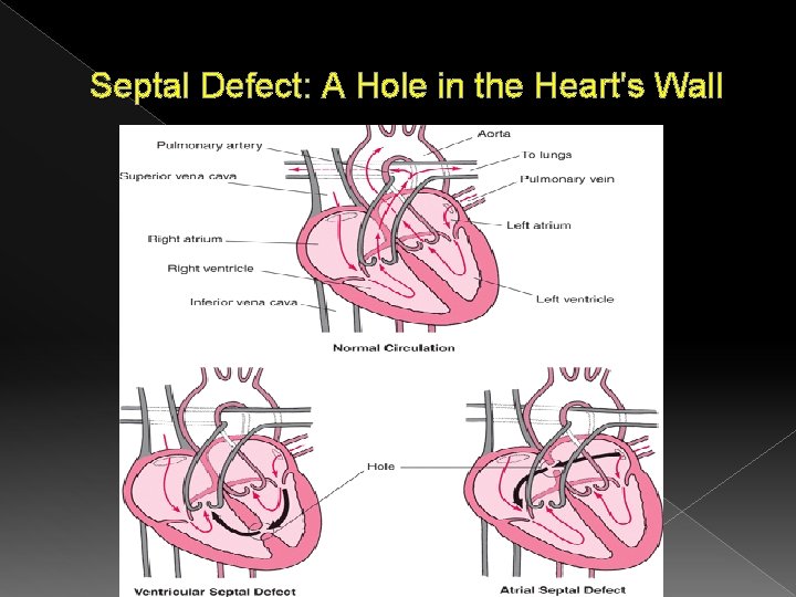 Septal Defect: A Hole in the Heart's Wall 