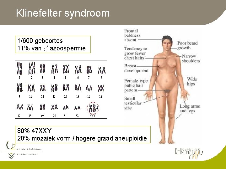 Klinefelter syndroom 1/600 geboortes 11% van ♂ azoospermie 80% 47 XXY 20% mozaiek vorm