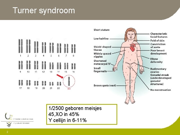 Turner syndroom 1/2500 geboren meisjes 45, XO in 45% Y cellijn in 6 -11%