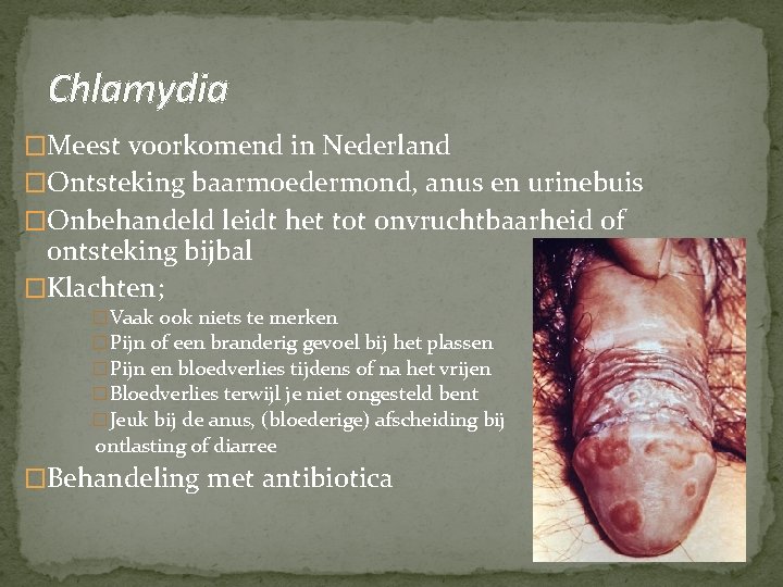 Chlamydia �Meest voorkomend in Nederland �Ontsteking baarmoedermond, anus en urinebuis �Onbehandeld leidt het tot