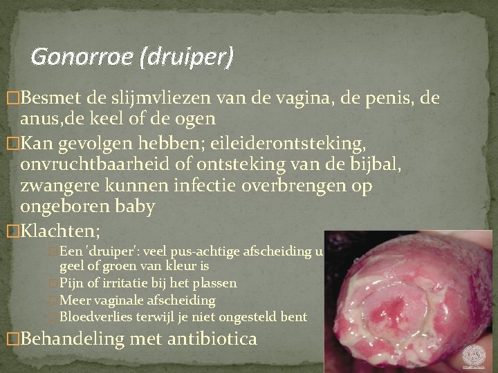 Gonorroe (druiper) �Besmet de slijmvliezen van de vagina, de penis, de anus, de keel