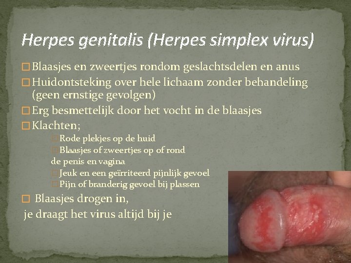Herpes genitalis (Herpes simplex virus) � Blaasjes en zweertjes rondom geslachtsdelen en anus �