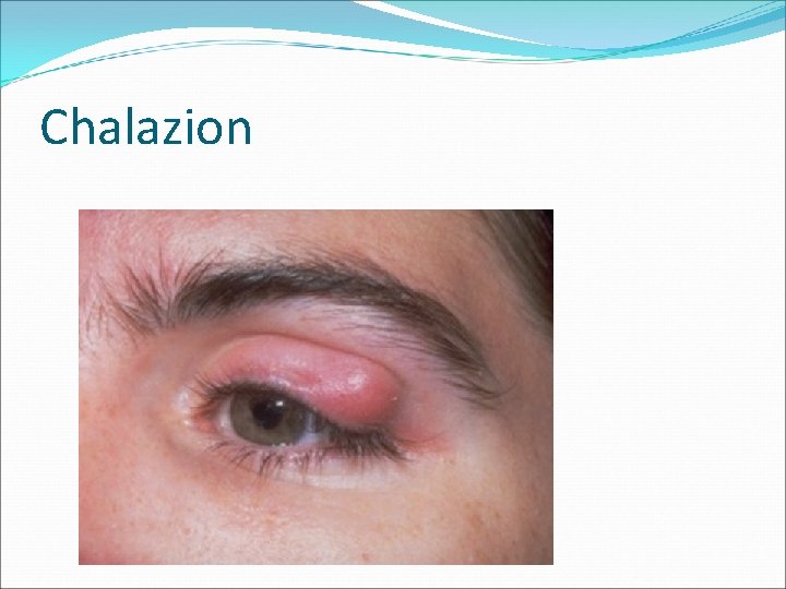 Chalazion 