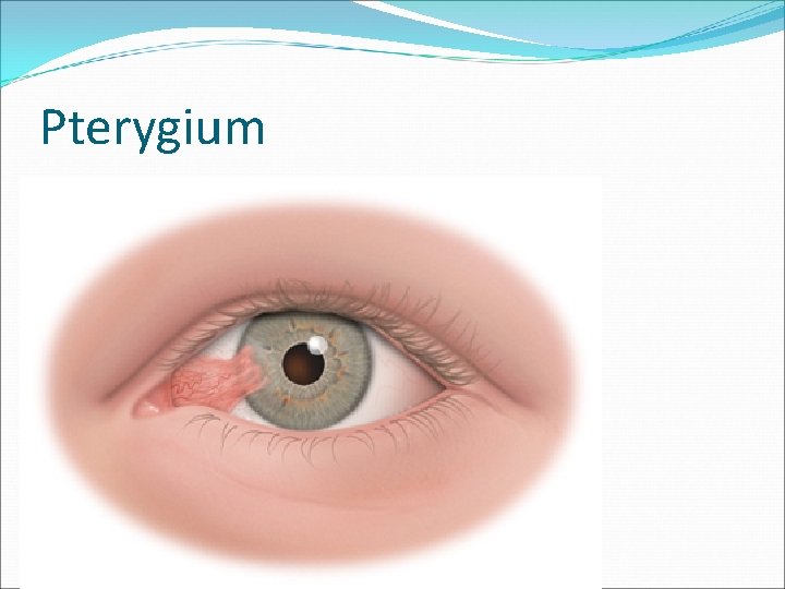 Pterygium 