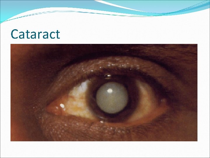 Cataract 