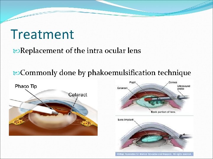 Treatment Replacement of the intra ocular lens Commonly done by phakoemulsification technique 