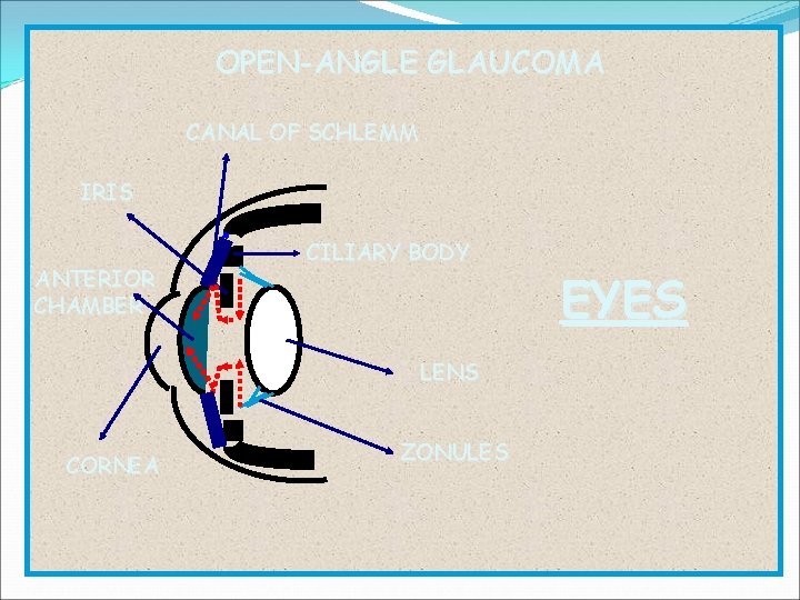 OPEN-ANGLE GLAUCOMA CANAL OF SCHLEMM IRIS ANTERIOR CHAMBER CILIARY BODY LENS CORNEA ZONULES EYES