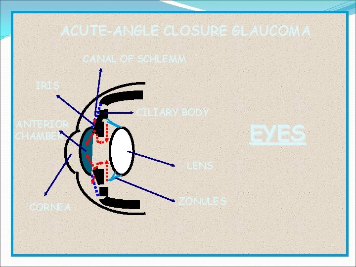 ACUTE-ANGLE CLOSURE GLAUCOMA CANAL OF SCHLEMM IRIS ANTERIOR CHAMBER CILIARY BODY LENS CORNEA ZONULES