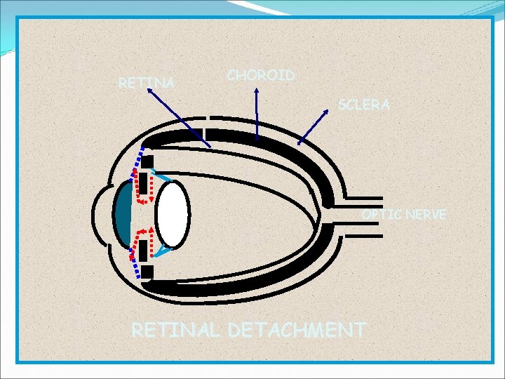 RETINA CHOROID SCLERA OPTIC NERVE RETINAL DETACHMENT 