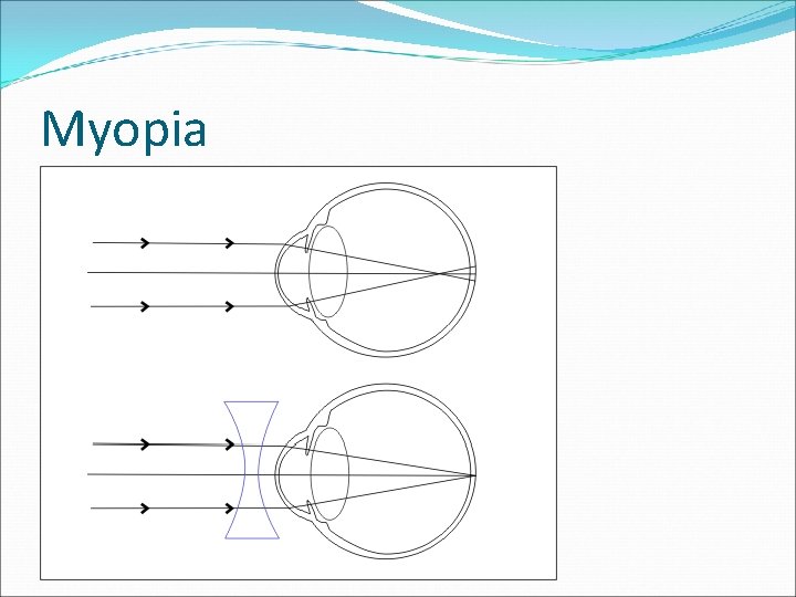 Myopia 